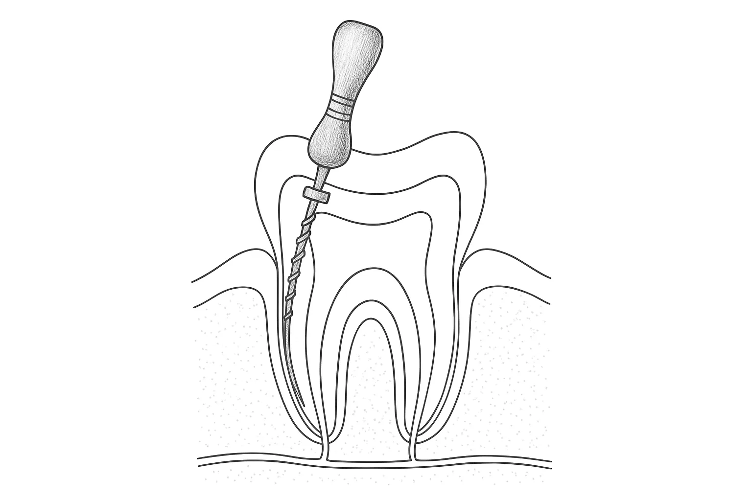 용이동 신경치료: 마취를 해도 아픈 이유
